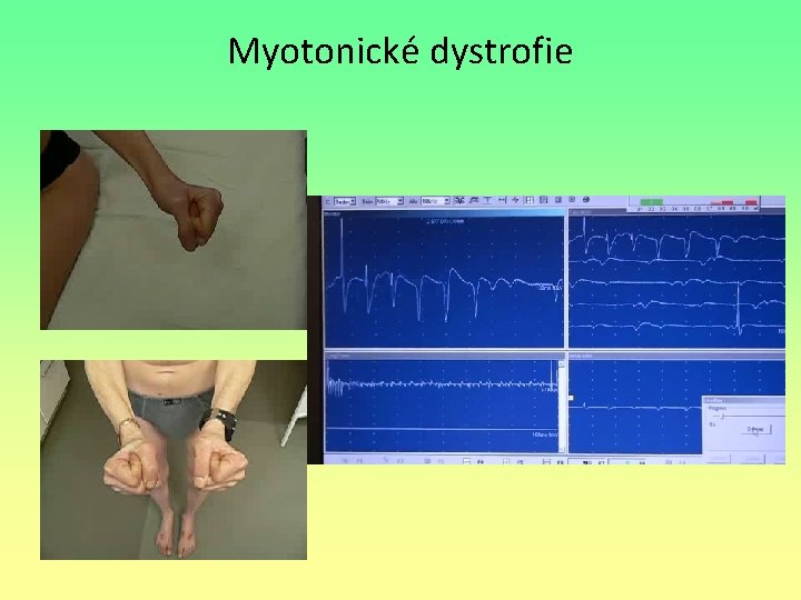 Myotonické dystrofie 