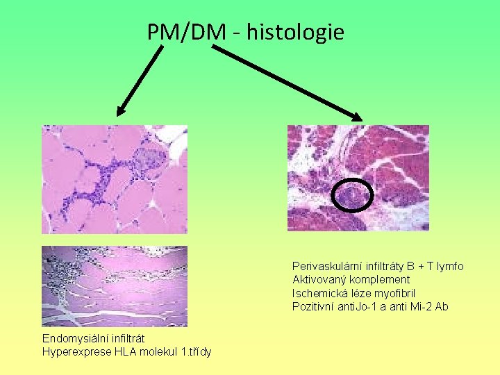 PM/DM - histologie Perivaskulární infiltráty B + T lymfo Aktivovaný komplement Ischemická léze myofibril