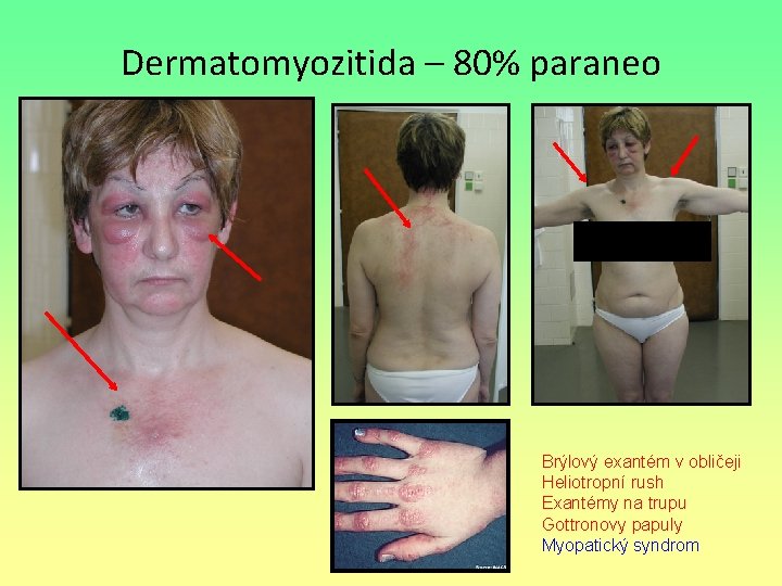 Dermatomyozitida – 80% paraneo Brýlový exantém v obličeji Heliotropní rush Exantémy na trupu Gottronovy