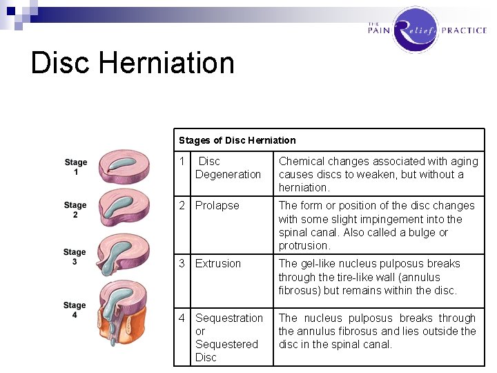 Disc Herniation Stages of Disc Herniation 1 Disc Degeneration Chemical changes associated with aging