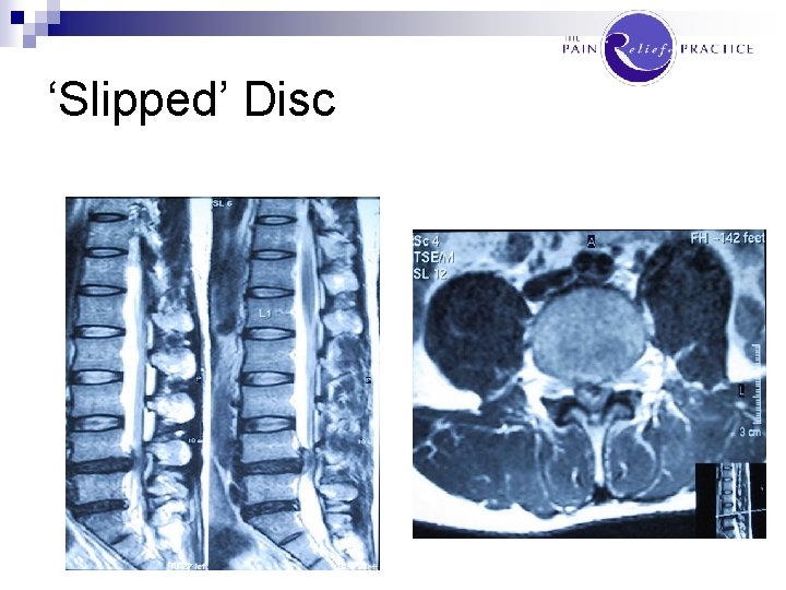 ‘Slipped’ Disc 