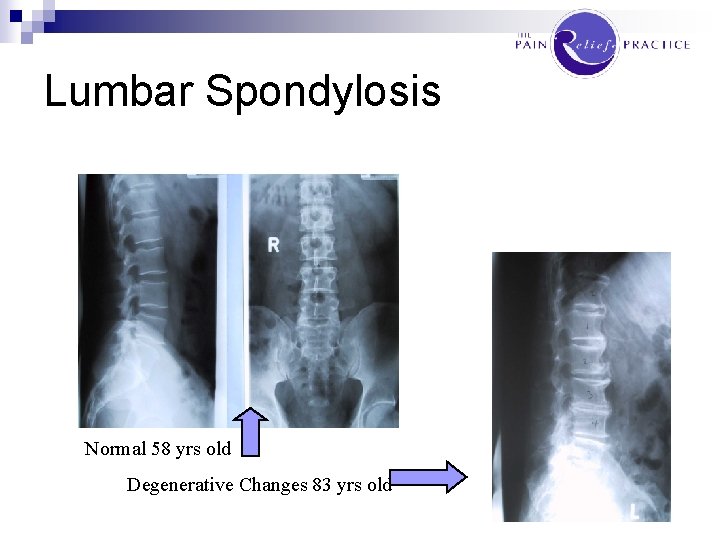 Lumbar Spondylosis Normal 58 yrs old Degenerative Changes 83 yrs old 