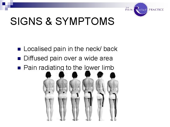 SIGNS & SYMPTOMS n n n Localised pain in the neck/ back Diffused pain
