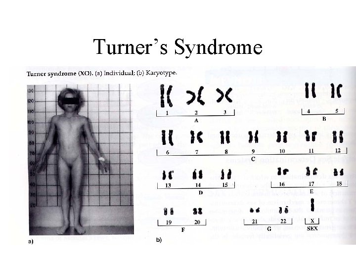 Turner’s Syndrome 