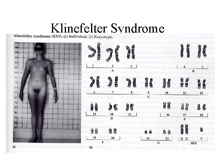 Klinefelter Syndrome 