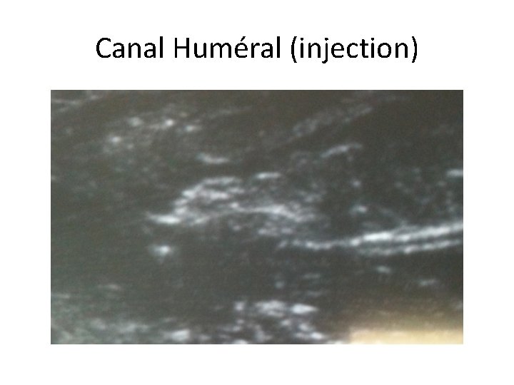 Canal Huméral (injection) 