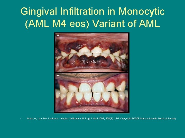 Gingival Infiltration in Monocytic (AML M 4 eos) Variant of AML • Mani, A,