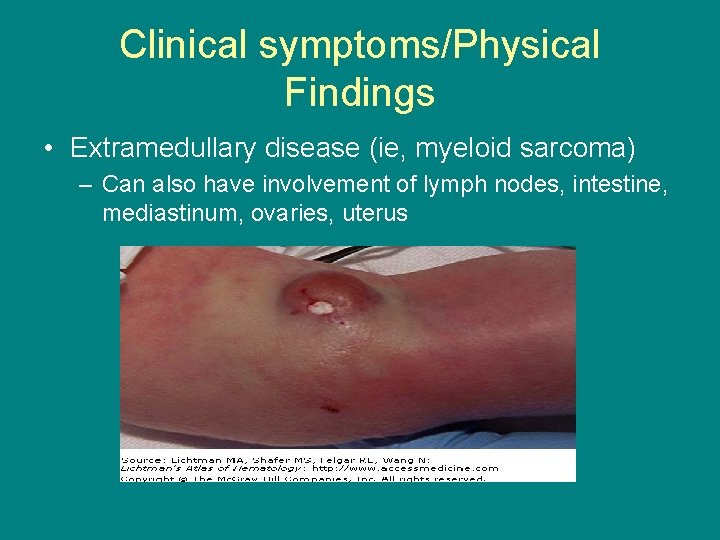 Clinical symptoms/Physical Findings • Extramedullary disease (ie, myeloid sarcoma) – Can also have involvement