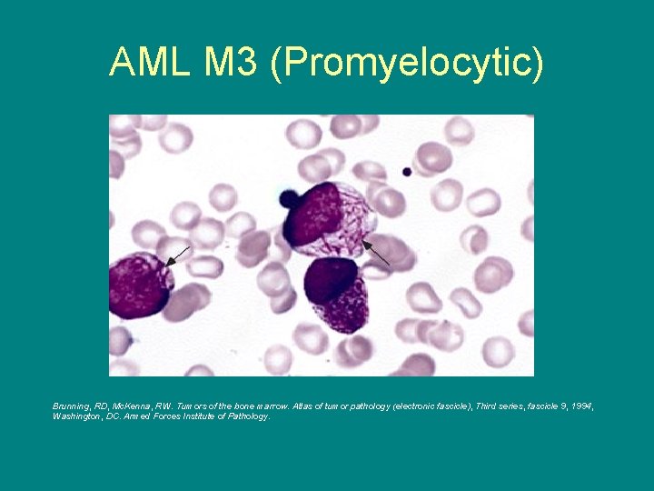 AML M 3 (Promyelocytic) Brunning, RD, Mc. Kenna, RW. Tumors of the bone marrow.