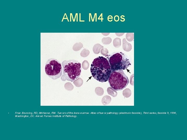 AML M 4 eos • From Brunning, RD, Mc. Kenna, RW. Tumors of the