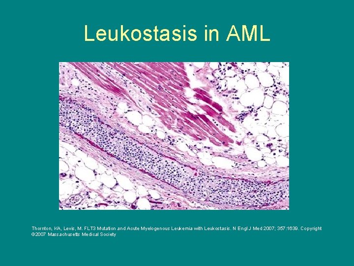 Leukostasis in AML Thornton, KA, Levis, M. FLT 3 Mutation and Acute Myelogenous Leukemia
