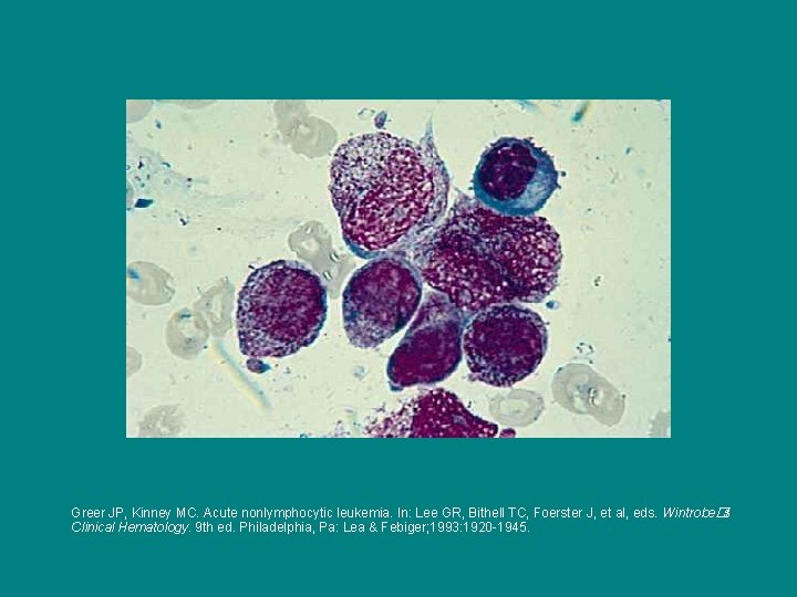 Greer JP, Kinney MC. Acute nonlymphocytic leukemia. In: Lee GR, Bithell TC, Foerster J,