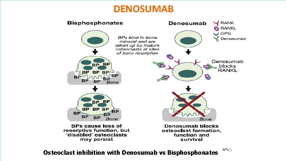 DENOSUMAB DDdd Osteoclast inhibition with Denosumab vs Bisphonates FACOLTA’ di MEDICINA E CHIRURGIA -