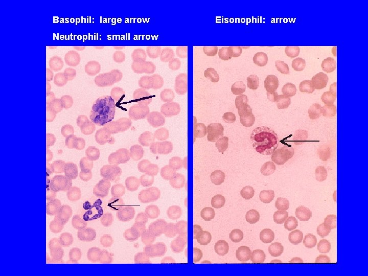 Basophil: large arrow Neutrophil: small arrow Eisonophil: arrow 
