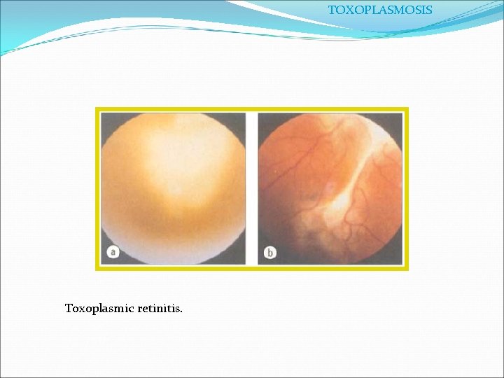 TOXOPLASMOSIS Toxoplasmic retinitis. 