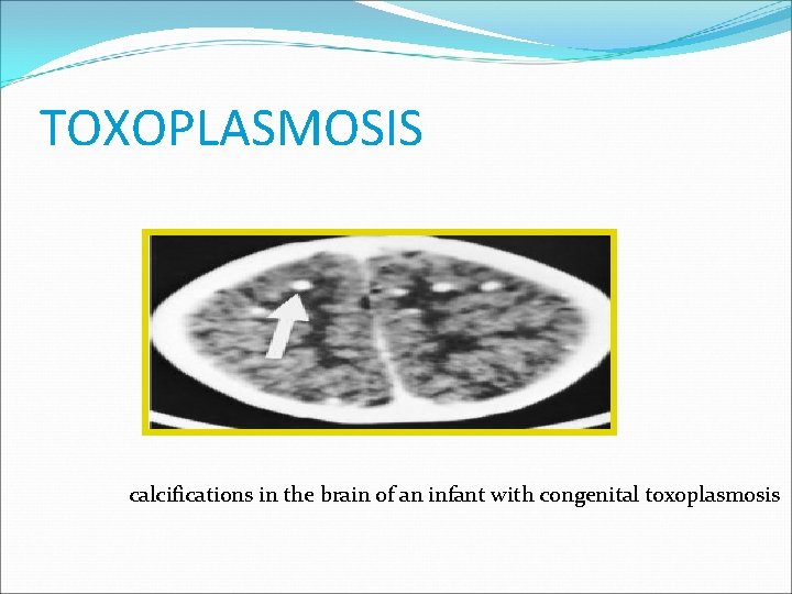 TOXOPLASMOSIS calcifications in the brain of an infant with congenital toxoplasmosis 