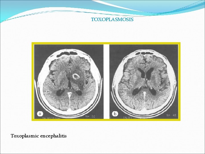 TOXOPLASMOSIS Toxoplasmic encephalitis 