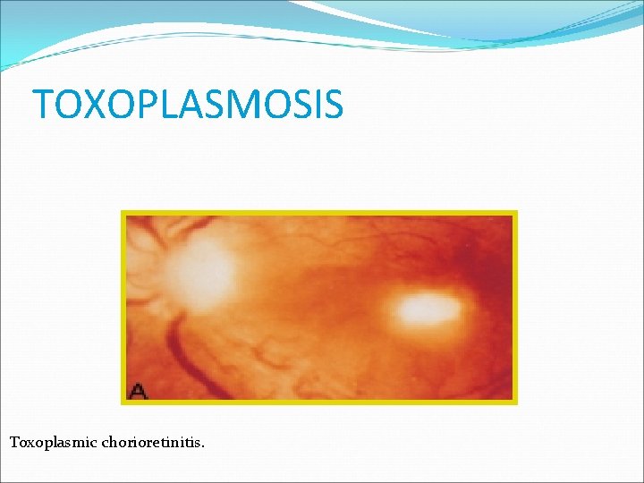 TOXOPLASMOSIS Toxoplasmic chorioretinitis. 