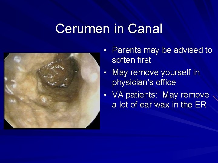 Cerumen in Canal • Parents may be advised to soften first • May remove