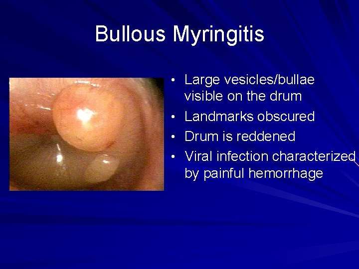 Bullous Myringitis • Large vesicles/bullae • • • visible on the drum Landmarks obscured