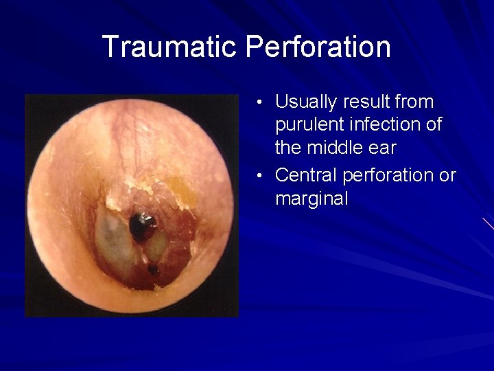 Traumatic Perforation • Usually result from purulent infection of the middle ear • Central