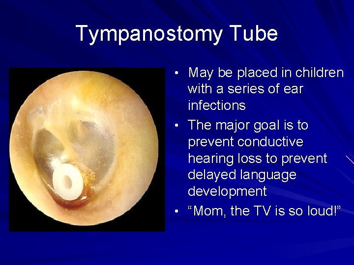 Tympanostomy Tube • May be placed in children with a series of ear infections
