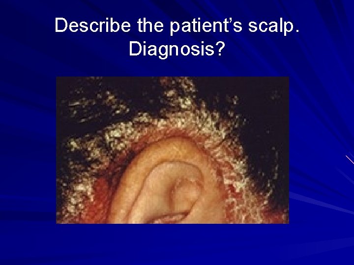 Describe the patient’s scalp. Diagnosis? 