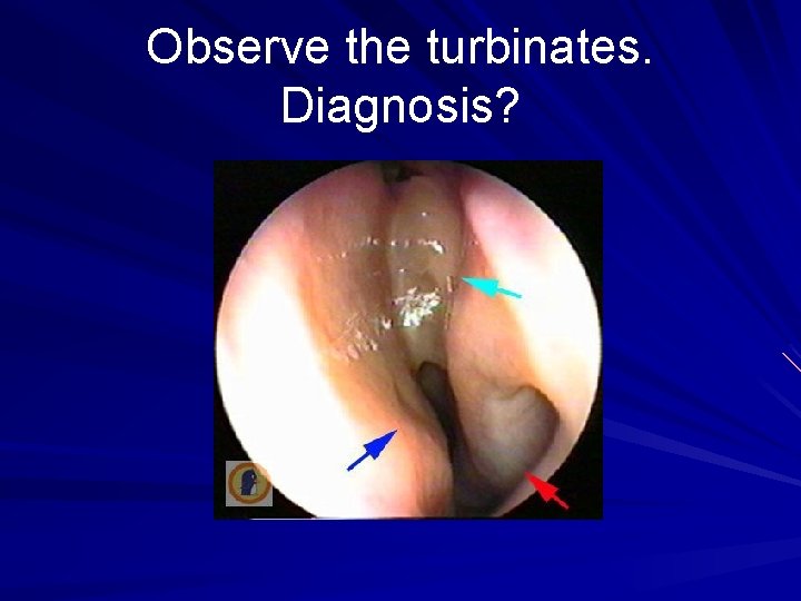 Observe the turbinates. Diagnosis? 