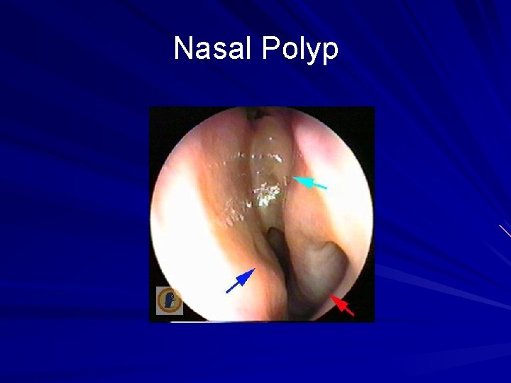 Nasal Polyp 