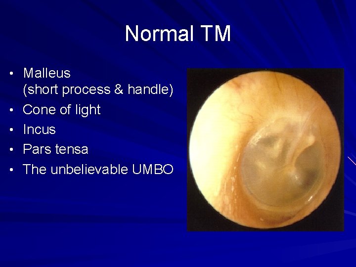 Normal TM • Malleus • • (short process & handle) Cone of light Incus
