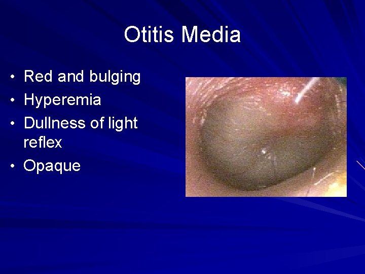 Otitis Media • Red and bulging • Hyperemia • Dullness of light reflex •
