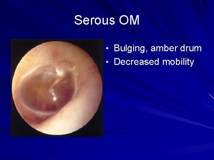 Serous OM • Bulging, amber drum • Decreased mobility 