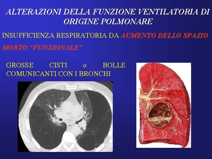 ALTERAZIONI DELLA FUNZIONE VENTILATORIA DI ORIGINE POLMONARE INSUFFICIENZA RESPIRATORIA DA AUMENTO DELLO SPAZIO MORTO