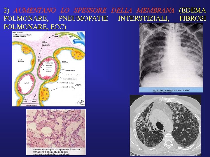 2) AUMENTANO LO SPESSORE DELLA MEMBRANA (EDEMA POLMONARE, PNEUMOPATIE INTERSTIZIALI, FIBROSI POLMONARE, ECC) 