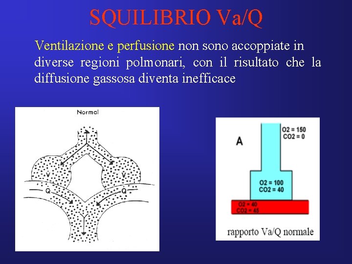 SQUILIBRIO Va/Q Ventilazione e perfusione non sono accoppiate in diverse regioni polmonari, con il