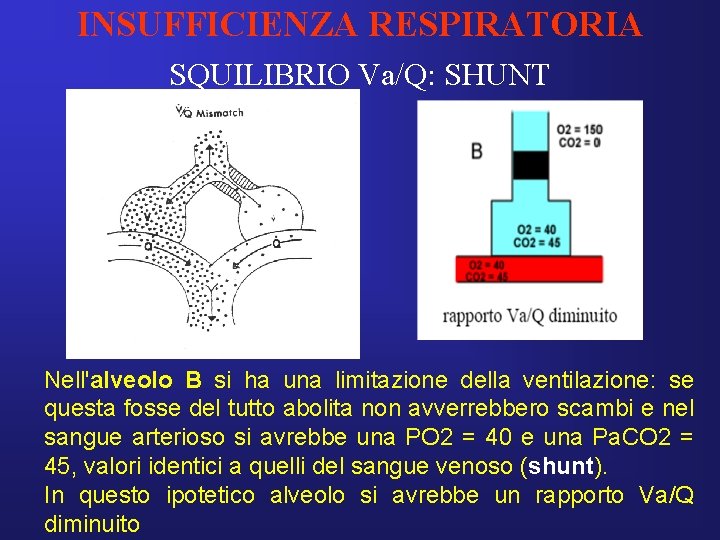 INSUFFICIENZA RESPIRATORIA SQUILIBRIO Va/Q: SHUNT Nell'alveolo B si ha una limitazione della ventilazione: se