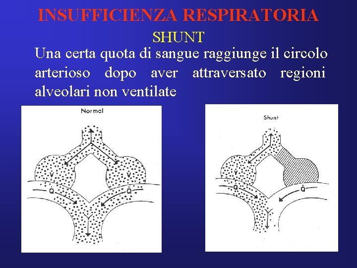 INSUFFICIENZA RESPIRATORIA SHUNT Una certa quota di sangue raggiunge il circolo arterioso dopo aver