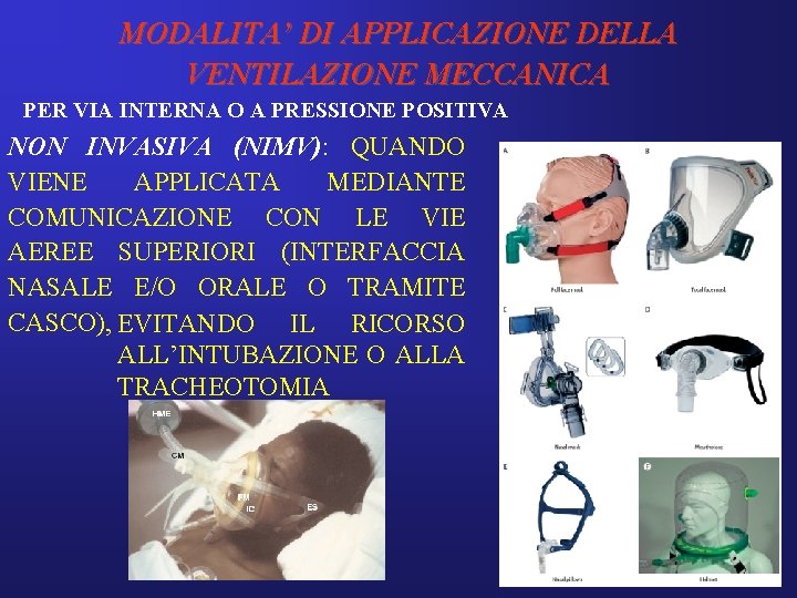 MODALITA’ DI APPLICAZIONE DELLA VENTILAZIONE MECCANICA PER VIA INTERNA O A PRESSIONE POSITIVA NON