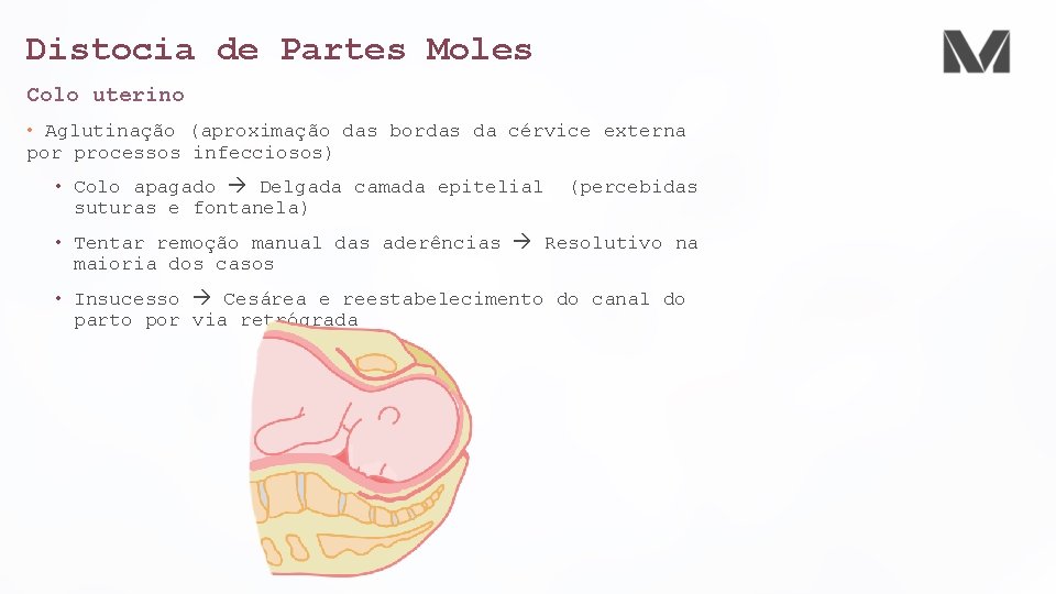 Distocia de Partes Moles Colo uterino • Aglutinação (aproximação das bordas da cérvice externa