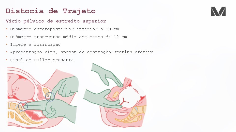 Distocia de Trajeto Vício pélvico de estreito superior • Diâmetro anteroposterior inferior a 10
