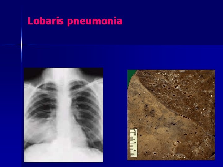 Lobaris pneumonia 