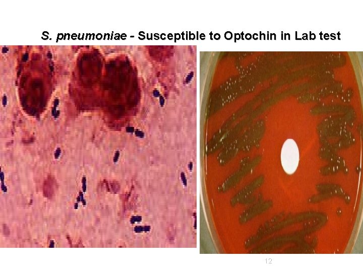 S. pneumoniae - Susceptible to Optochin in Lab test 12 