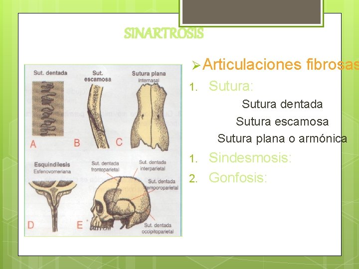 SINARTROSIS Ø Articulaciones fibrosas 1. Sutura: Sutura dentada Sutura escamosa Sutura plana o armónica