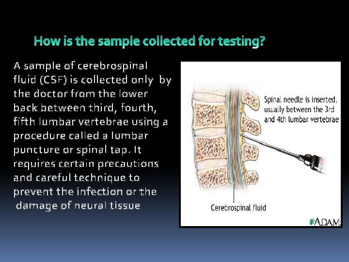 A sample of cerebrospinal fluid (CSF) is collected only by the doctor from the
