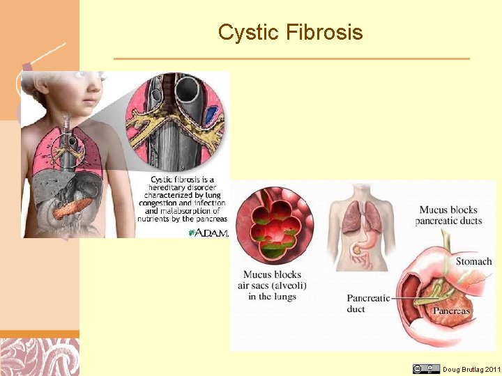 Cystic Fibrosis Doug Brutlag 2011 
