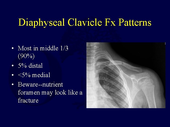 Diaphyseal Clavicle Fx Patterns • Most in middle 1/3 (90%) • 5% distal •