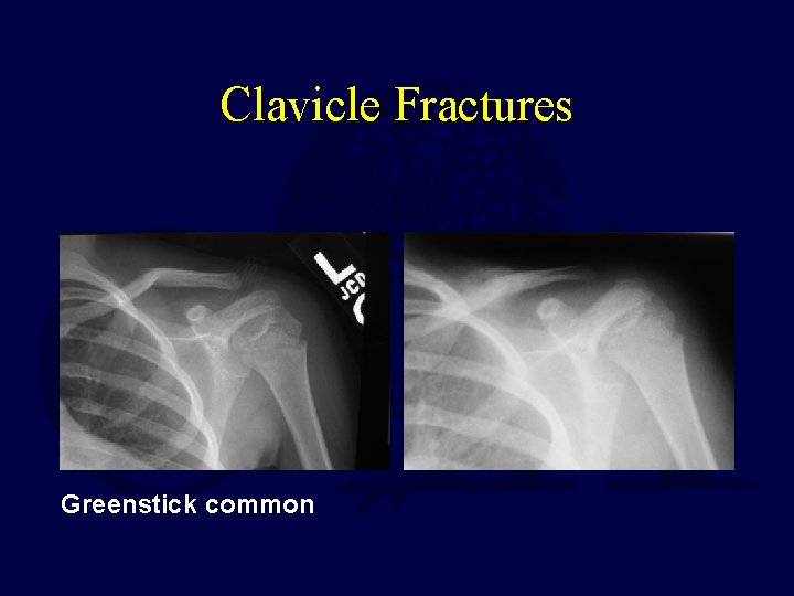 Clavicle Fractures Greenstick common 