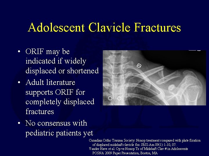 Adolescent Clavicle Fractures • ORIF may be indicated if widely displaced or shortened •