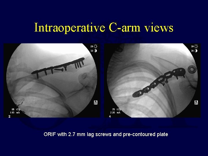 Intraoperative C-arm views ORIF with 2. 7 mm lag screws and pre-contoured plate 