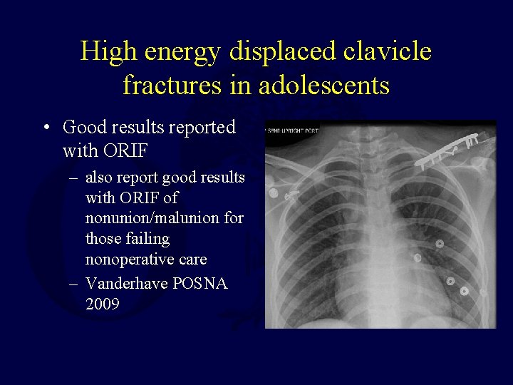 High energy displaced clavicle fractures in adolescents • Good results reported with ORIF –